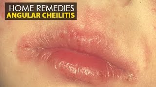 Angular Cheilitis - Home Remedies (Natural Treatment) | Health Education screenshot 2