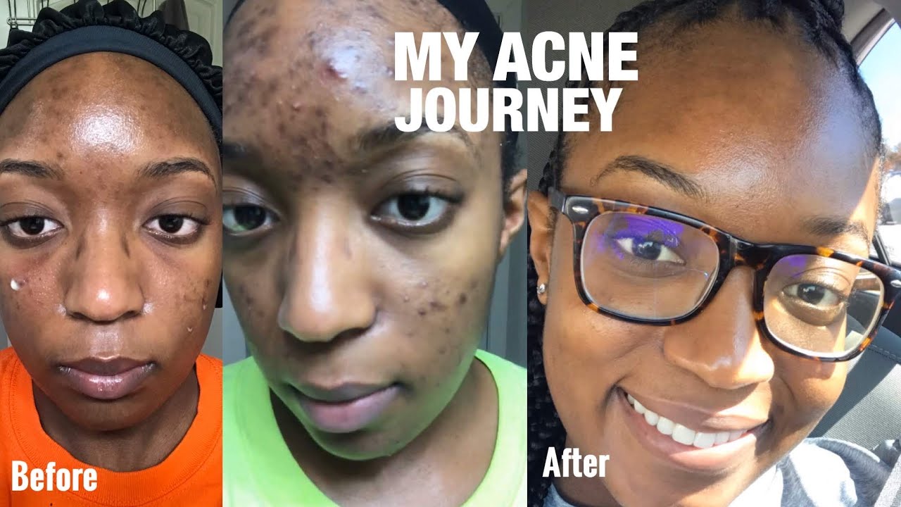 MY ACNE JOURNEY: How I cleared my skin | ACNE.ORG - YouTube