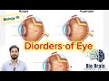 Disorders of eye | myopia & hypermetropia | class 10th @BioBrain_by_rafahkhan