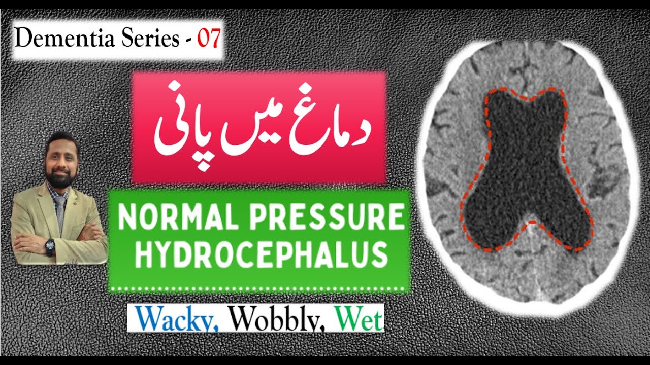 Normal Pressure Hydrocephalus: Be Hopeful: Urdu/Hindi |Dr. Ali Hassan