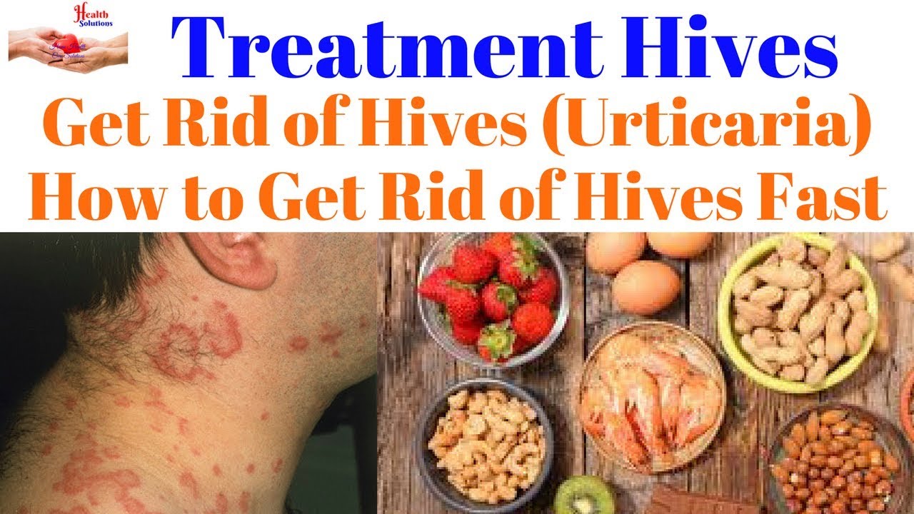 Treatment Hives Get Rid Of Hives Urticaria How To Get Rid Of