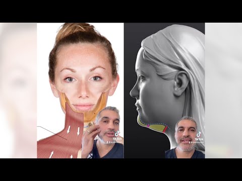 Video: Kas yra nechirurginis kaklo pakėlimas?