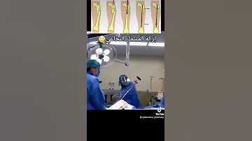 إزالة المسمار النخاعي من العظم بعد الشفاء 