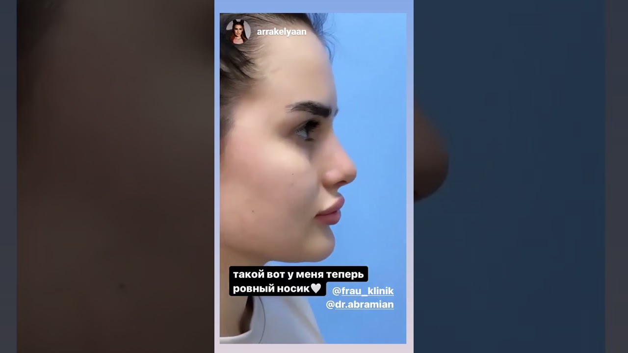 Карина аракелян увеличила губы
