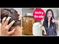 Get Rid Of ITCHY Scalp Fast | Best Tips & Home Remedies | Sushmita's Diaries