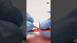 This Needle Melts Inside Your Body. 💉😱