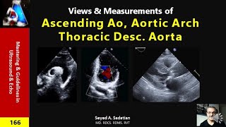 Views & Measurements of Ascending Ao, Aortic Arch & thoracic Desc. Ao