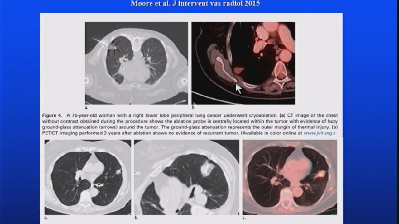 When to consider Non-Operative Ablative Therapies for Early Stage Lung Cancer