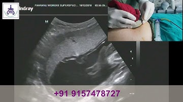 Intrauterine Transfusion IUT Procedure by Dr. Jayesh Patel, at Paaranu IVF, Surat, Gujarat, India.