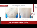 لیزر موهای زائد فیلم لیزر موهای زائد کلینیک پوست و مو هلیا شماره 23 