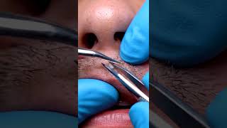 🔍 Sebum Plug Extraction #sebumplugremoval #asmrextraction #blackheadremoval #skincare #satisfyingvi