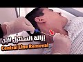 اساسيات التمريض 25 إزاي تشيل Central Line بخطوات آمنة ومن غير ما تعر ض المريض للخطر 