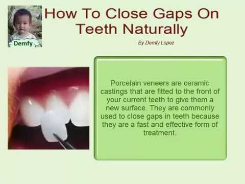 How To Close Gaps On Teeth Naturally - YouTube