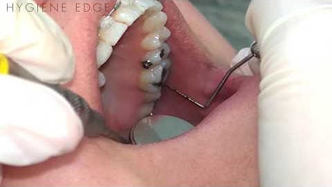 Nauwkeurige meting van lijnhoek tot lijnhoek