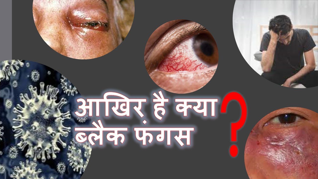 Aakhir Hai Kya Black_Fungus Kya ye covid19 se hota hai 