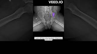 Drehmann's sign positive in a case of SCFE - slipped capital femoral epiphysis