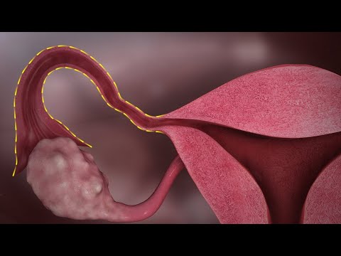 Vídeo: Koilocitosis: Diagnóstico, Tratamiento Y Su Relación Con El Cáncer