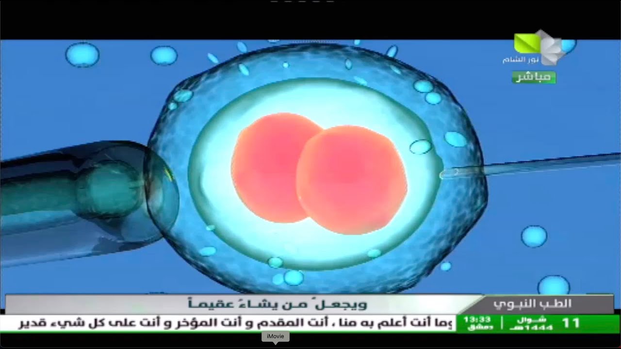 أطفال الأنابيب (الإخصاب خارج الجسم): الإستطبابات والإجراء والنتائج والتجميد - الدكتور مروان الحلبي