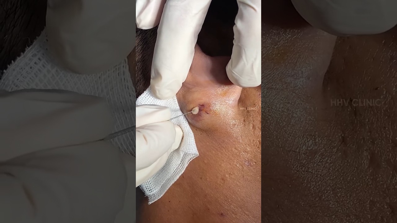 Nặn mụn u nang bã ở tai