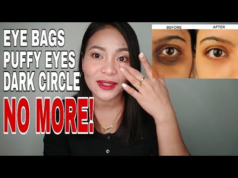 HOW TO REMOVED DARK CIRCLES AND EYE BAGS IN 5 DAYS || SOLUSYON SA EYEBAGS!