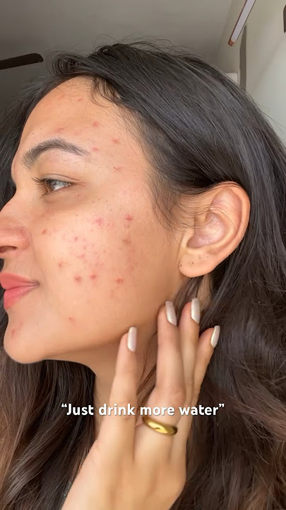 Just drink more water people with no acne will never get it, as if this can cure my hormonal acne.💔