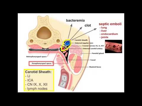 Lemierre&rsquo;s Syndrome: "EM in 5"