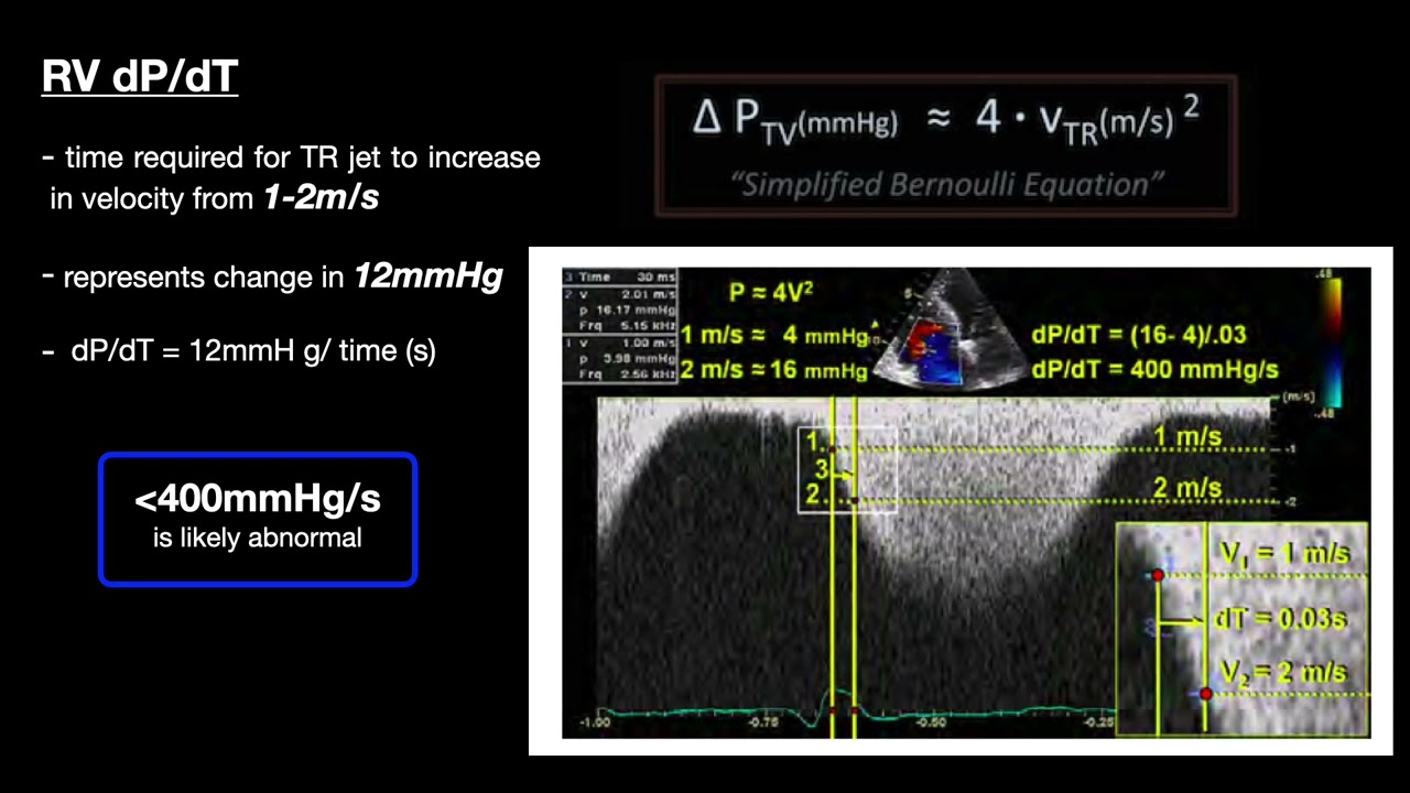 RV systolic Function
