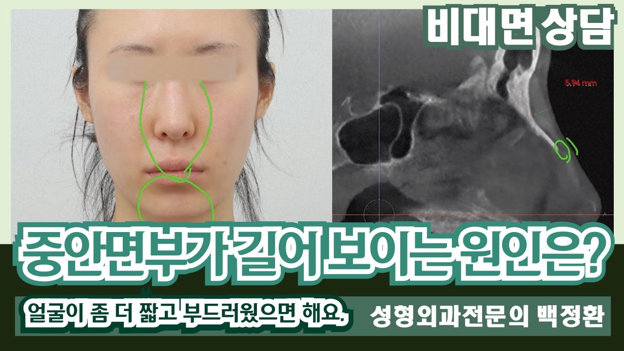 (SUB) 중안면부가 길어 보이는 원인은? [비대면상담 586] / What causes the midface to look ...