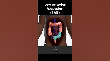 Low Anterior Resection (LAR)