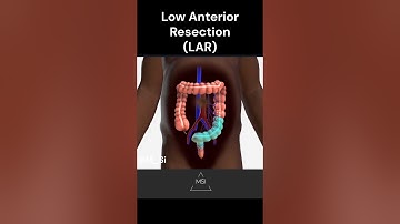 Low Anterior Resection (LAR)