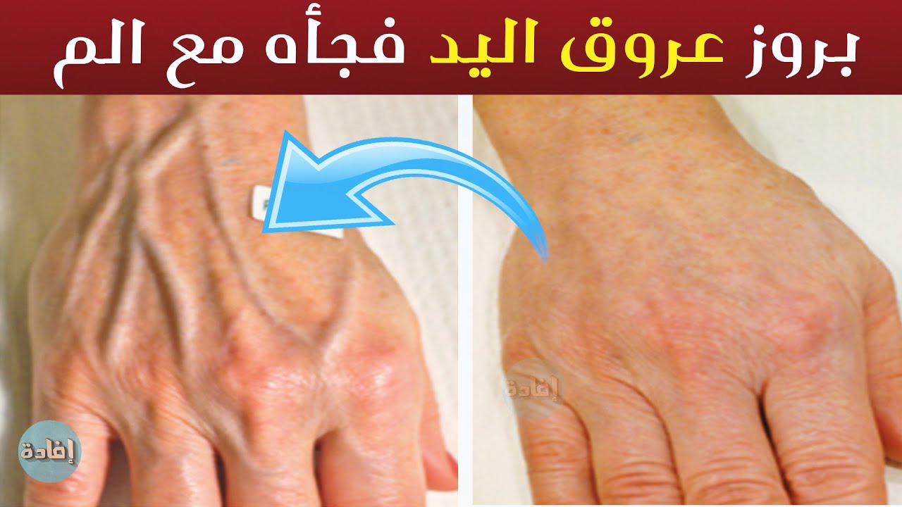 بروز عروق اليد فجأه مع الم - YouTube