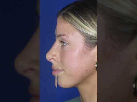 Video thumbnail: Rhinoplasty Experience: Patient Reveal and Reaction #rhinoplastysurgeon #nosejob #shorts · Dr. Anthony Corrado