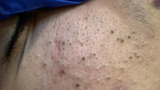 DEEP PORES CLEANING AND BLACKHEAD REMOVAL | FACIAL CARE ROUTINE