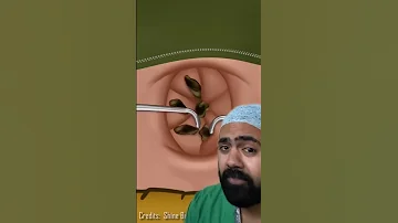 Doctor Reacts To Lost Baggage In Bellybutton