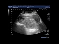 Ultrasound Video showing an incomplete abortion with retained products of conception.