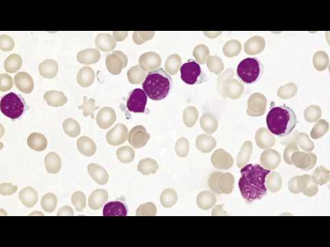 Video: Predikce Krevní Transfuze Peripartem: Zaměření Na Charakteristiky Před Těhotenstvím