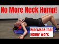 Neck Hump Removal Exercises - 5 Effective Exercises