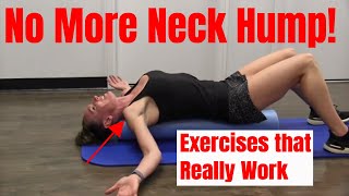 Neck Hump 5 Effective Exercises