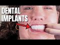 How i paid for my dental implants