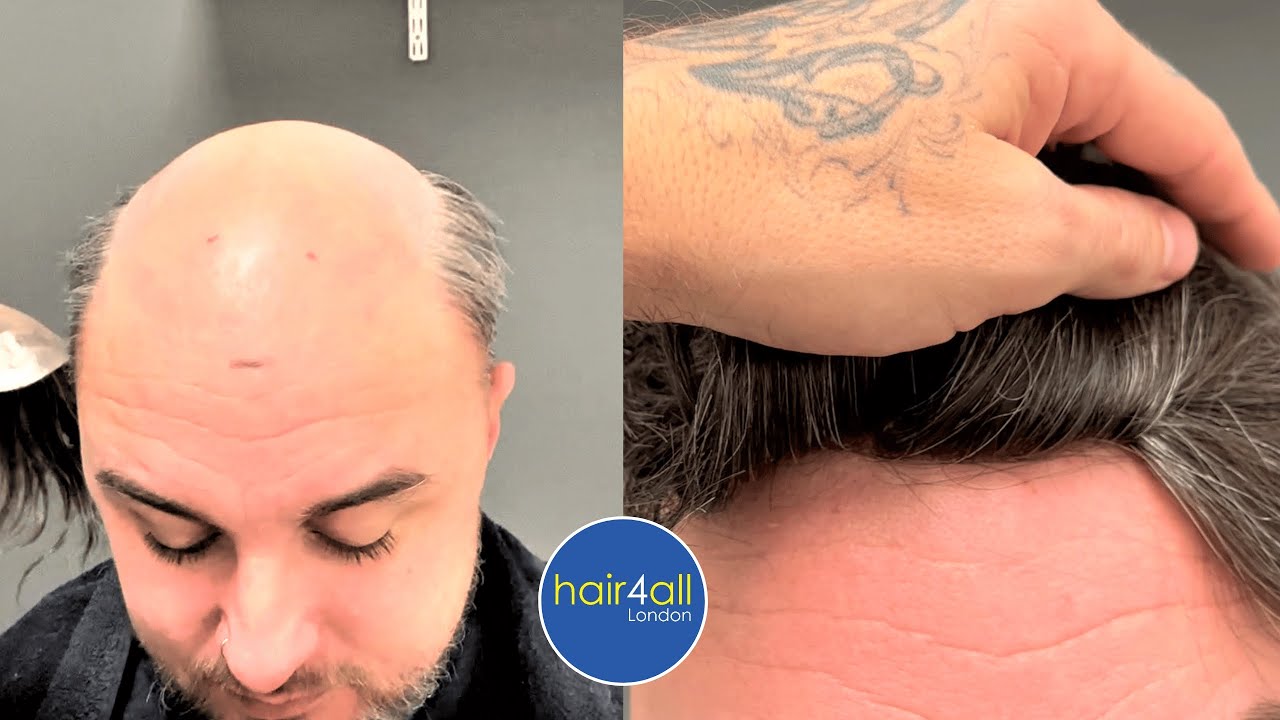 So Real! Hair System Hair Line Before & After NonSurgical Hair