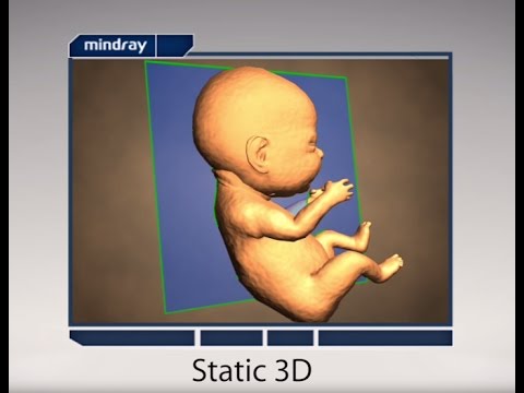 Video: 3D Ultrazvuk Plodu - Vlastnosti Správania A účinku Na Plod