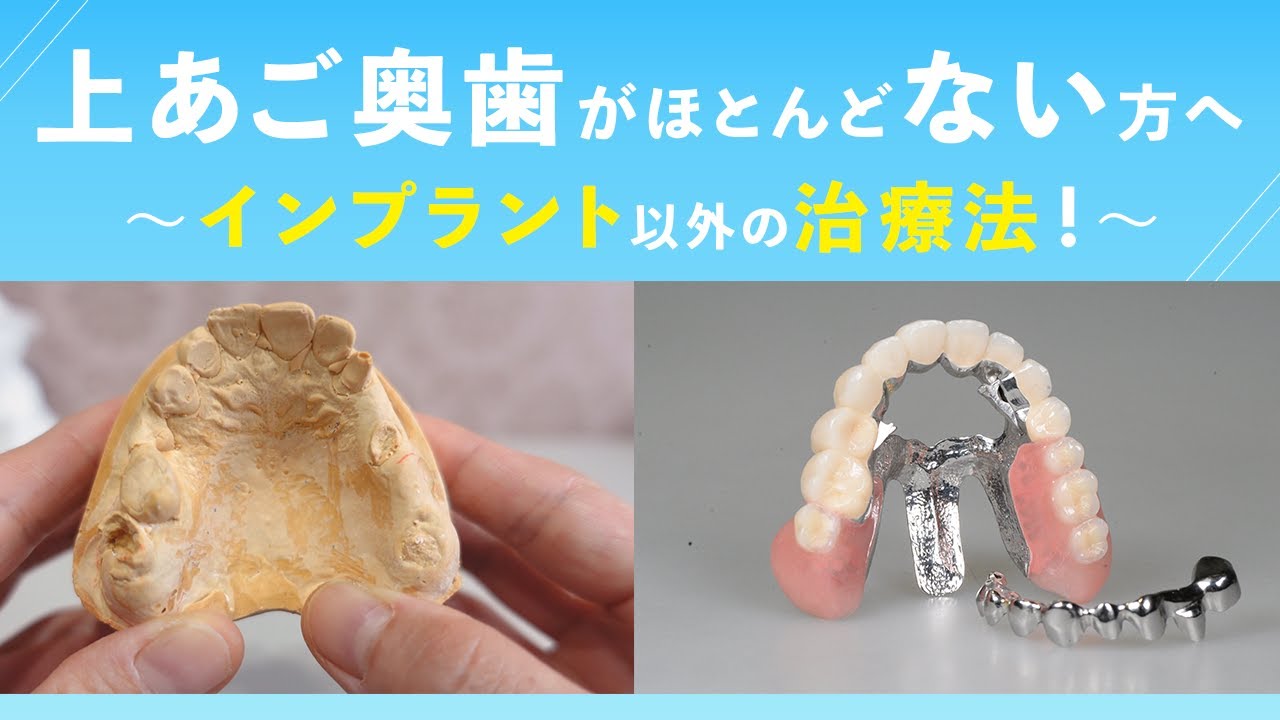 上あご奥歯がほとんどない方へ 〜インプラント以外の治療法!〜 - YouTube