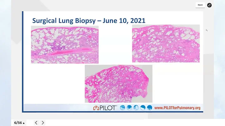 IPF Management and Antifibrotic Therapy
