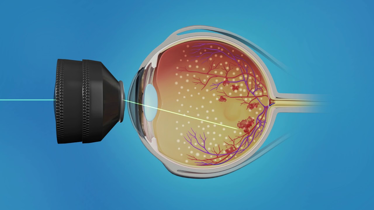 Windy City Retina- Central Retinal Vein Occlusion (CRVO) Treatment