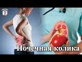 "На приеме у врача" Выпуск 61 - Почечная колика