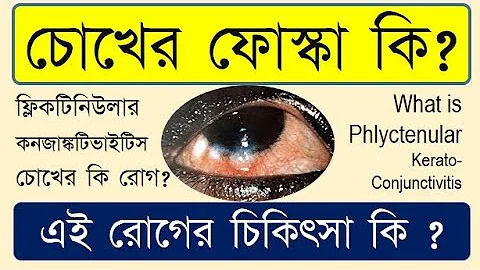 Phlyctenulosis: causes, symptoms and treatment. # ...