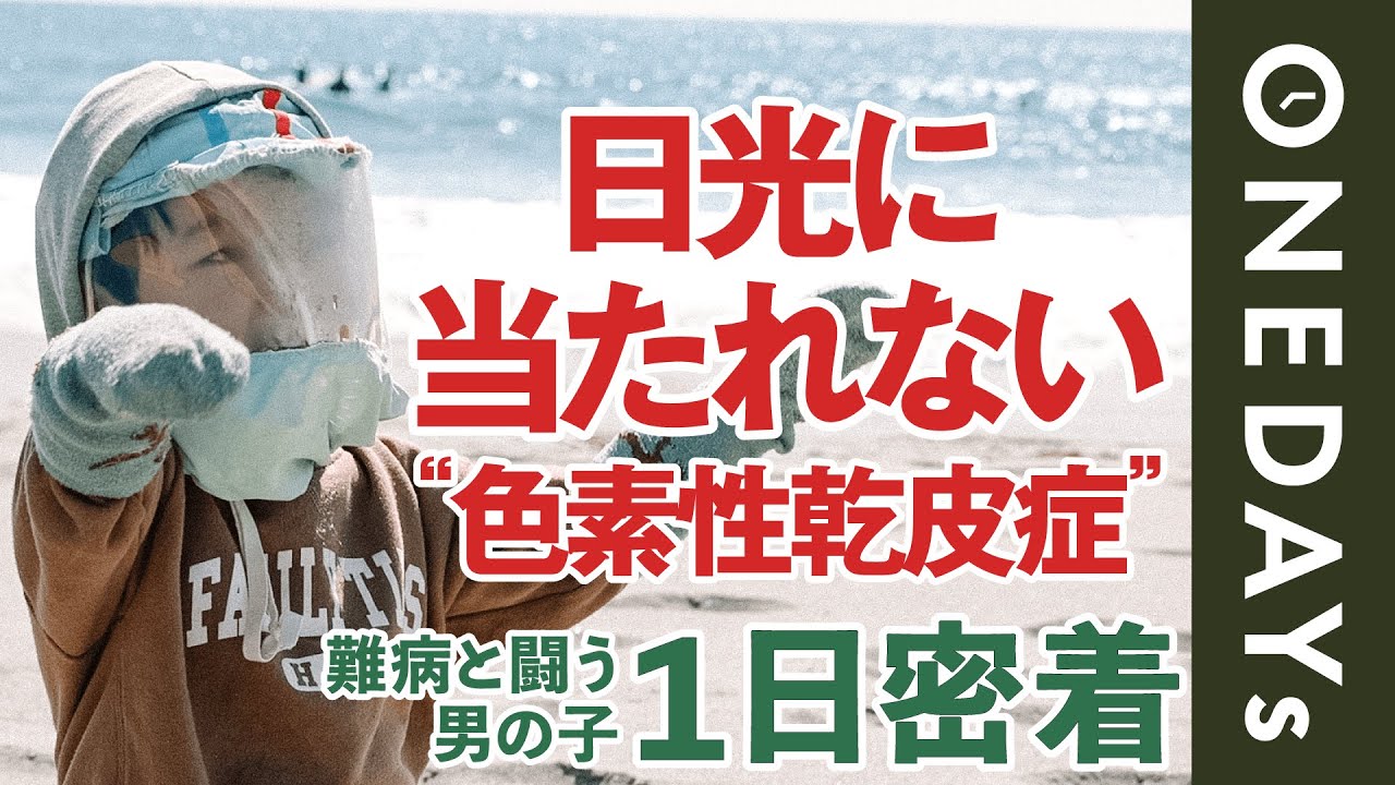 寿命は約20〜30歳】日光に当たれない難病の男の子に1日密着してみた