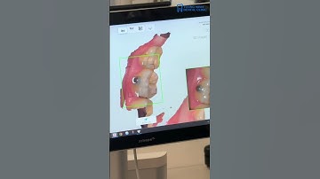 Tạm biệt phương pháp lấy dấu răng truyền thống bằng công nghệ Scan 3D hiện đại #scan #shortvideo