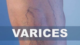 ☞ Remedios caseros para las venas varicosas o arañitas – Como eliminar las varices en las piernas(Las venas varicosas son un problema común en la que las venas anormalmente grandes aparecen cerca de la superficie de la piel. Por lo general ocurren en ..., 2016-07-13T19:43:53.000Z)
