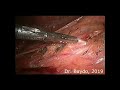 Laparoscopic left retro-peritoneal dissection